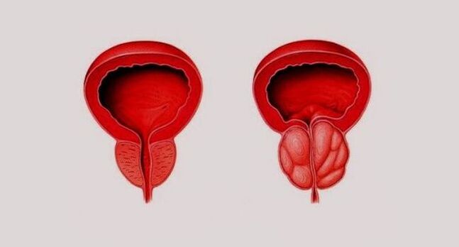 Healthy (left) and inflamed prostate due to prostatitis (right)