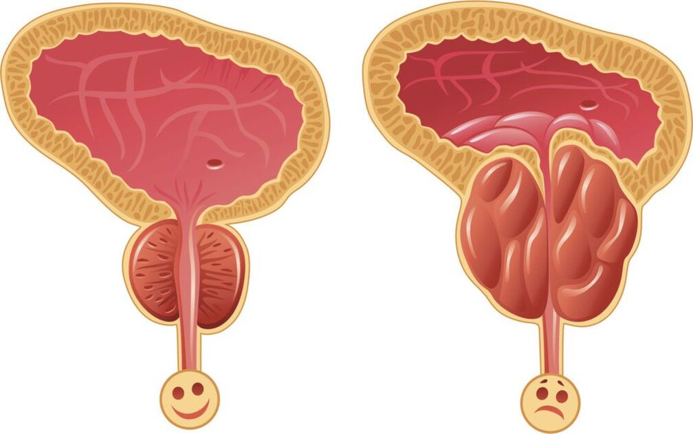 healthy and diseased prostate