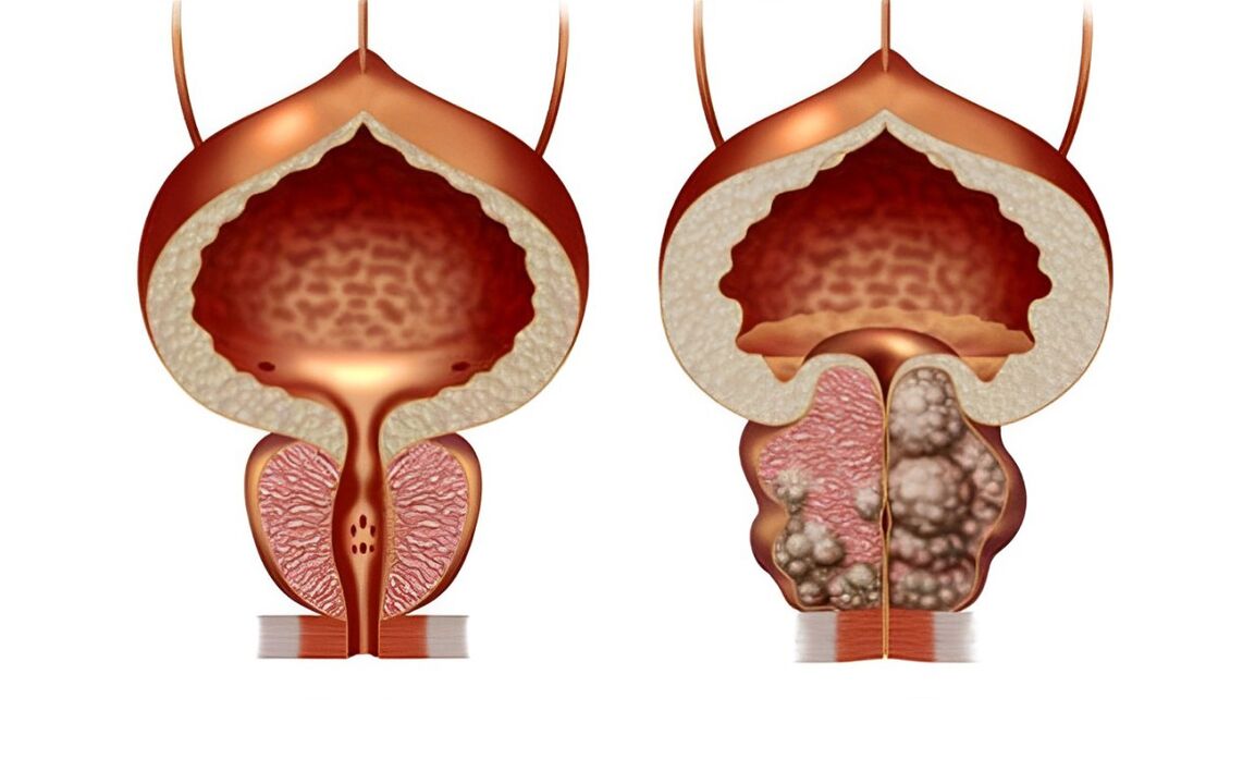 what does prostatic adenoma look like