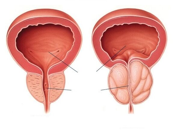 normal and enlarged prostate